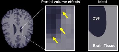 Estimation of free water-corrected microscopic fractional anisotropy